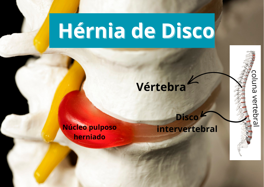 Ilustração da hérnia de disco